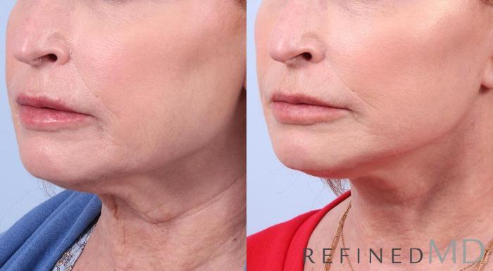 Before & After Facelift Case 1025 View 2 View in Los Gatos & San Jose, CA