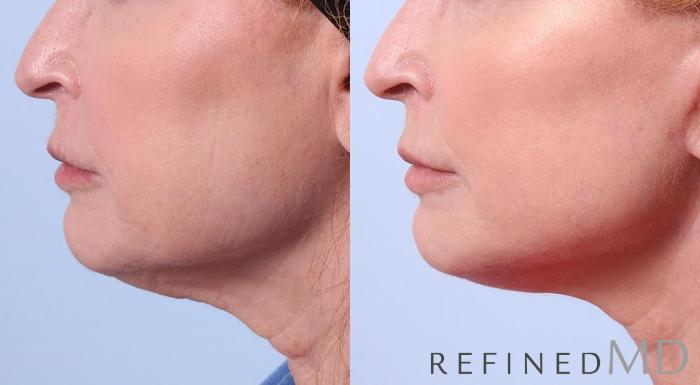 Before & After Facelift Case 1025 View 3 View in Los Gatos & San Jose, CA