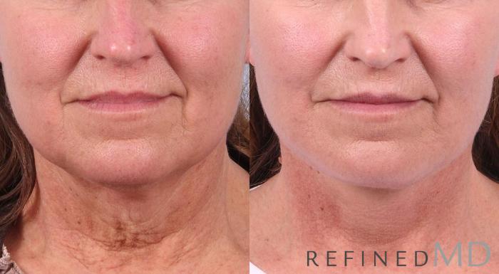 Before & After Facelift Case 1026 View 1 View in Los Gatos & San Jose, CA