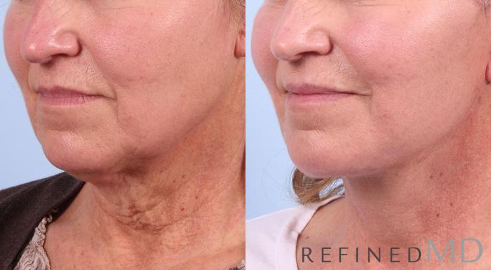 Before & After Facelift Case 1026 View 2 View in Los Gatos & San Jose, CA