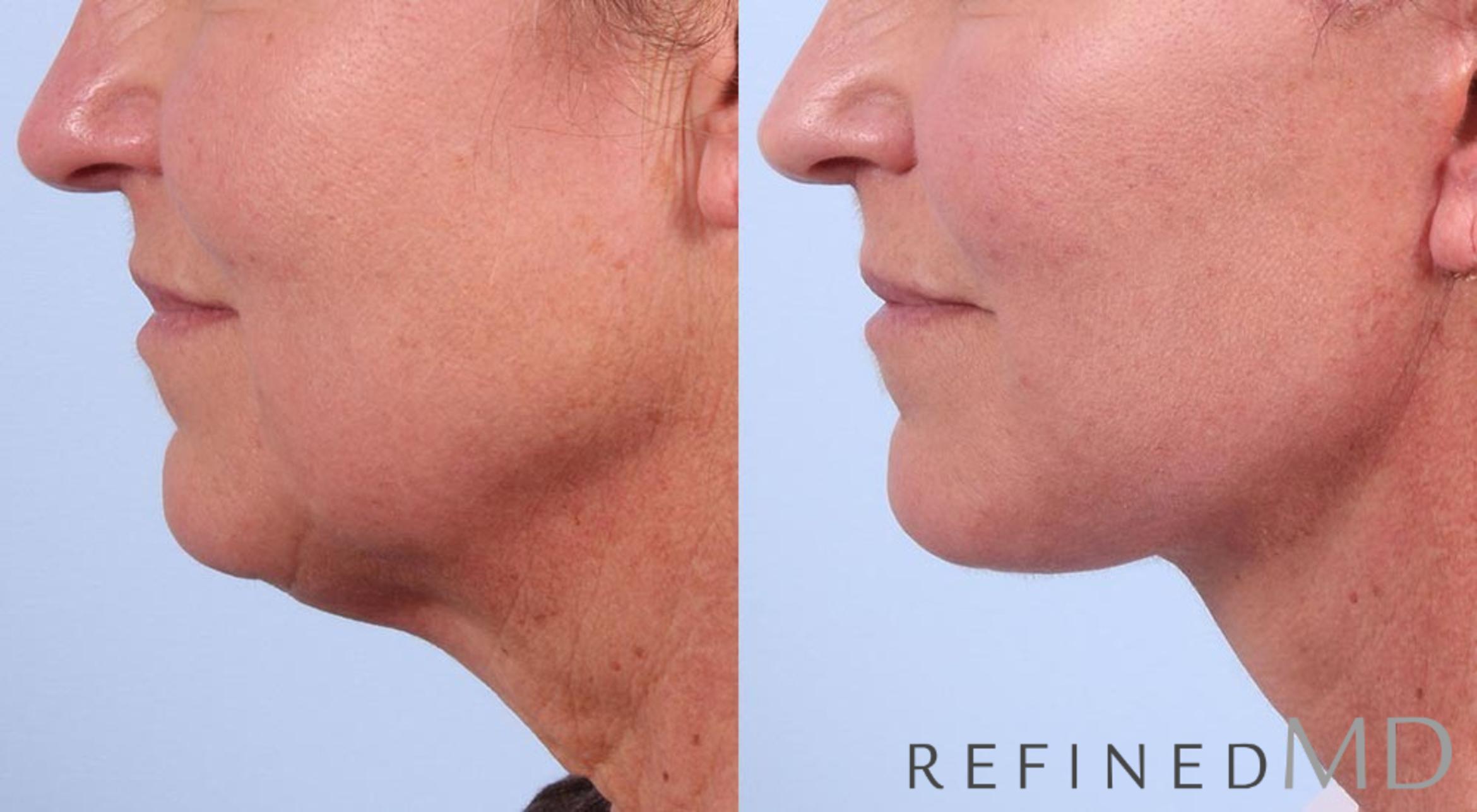 Before & After Facelift Case 1026 View 3 View in Los Gatos & San Jose, CA