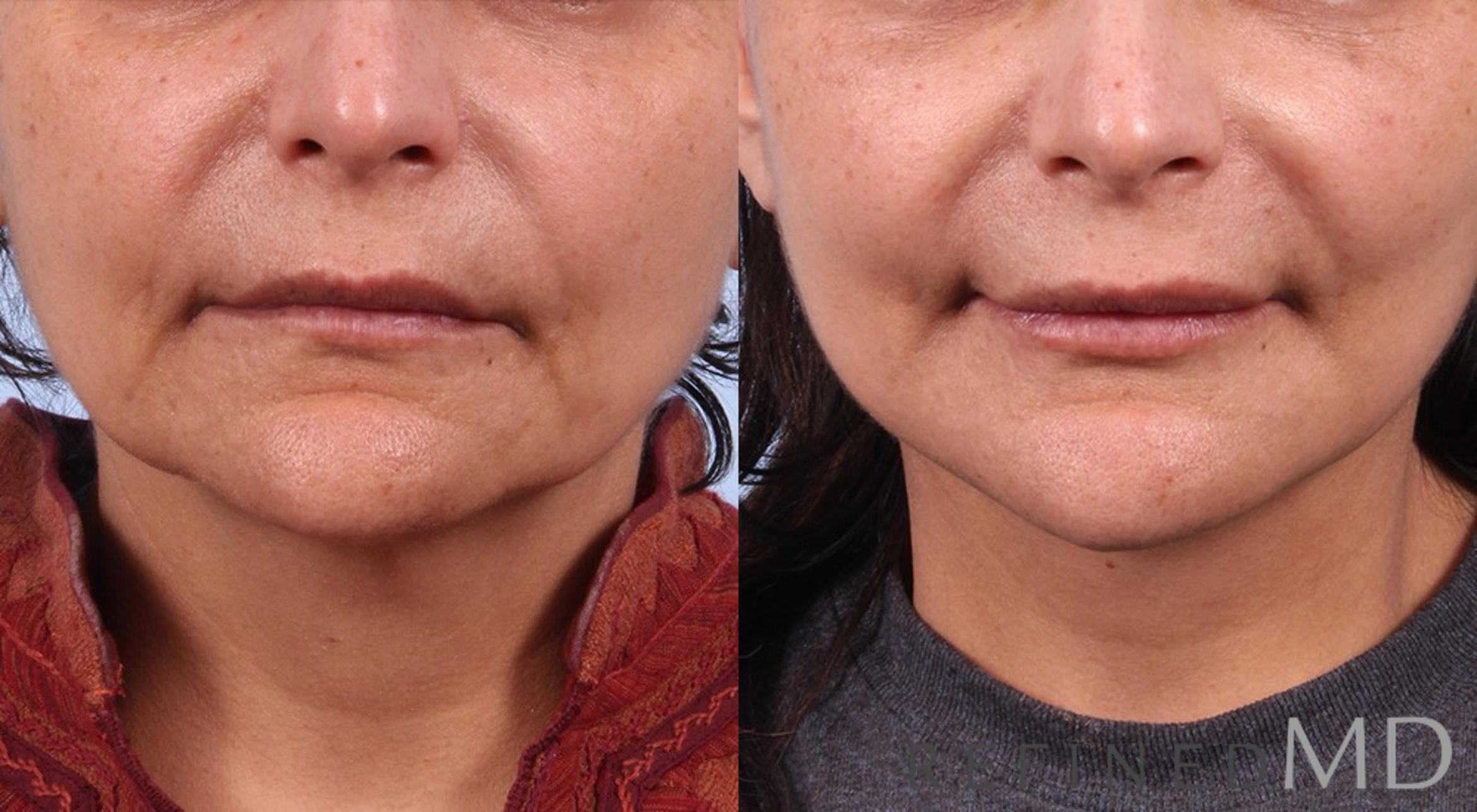Before & After Facelift Case 1027 View 1 View in Los Gatos & San Jose, CA