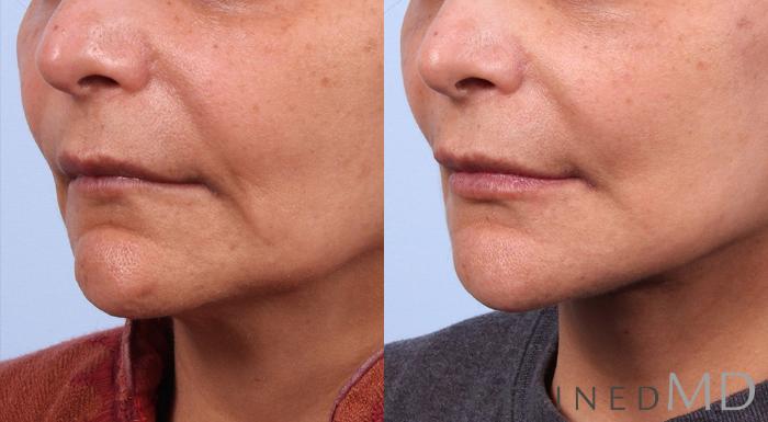 Before & After Facelift Case 1027 View 2 View in Los Gatos & San Jose, CA