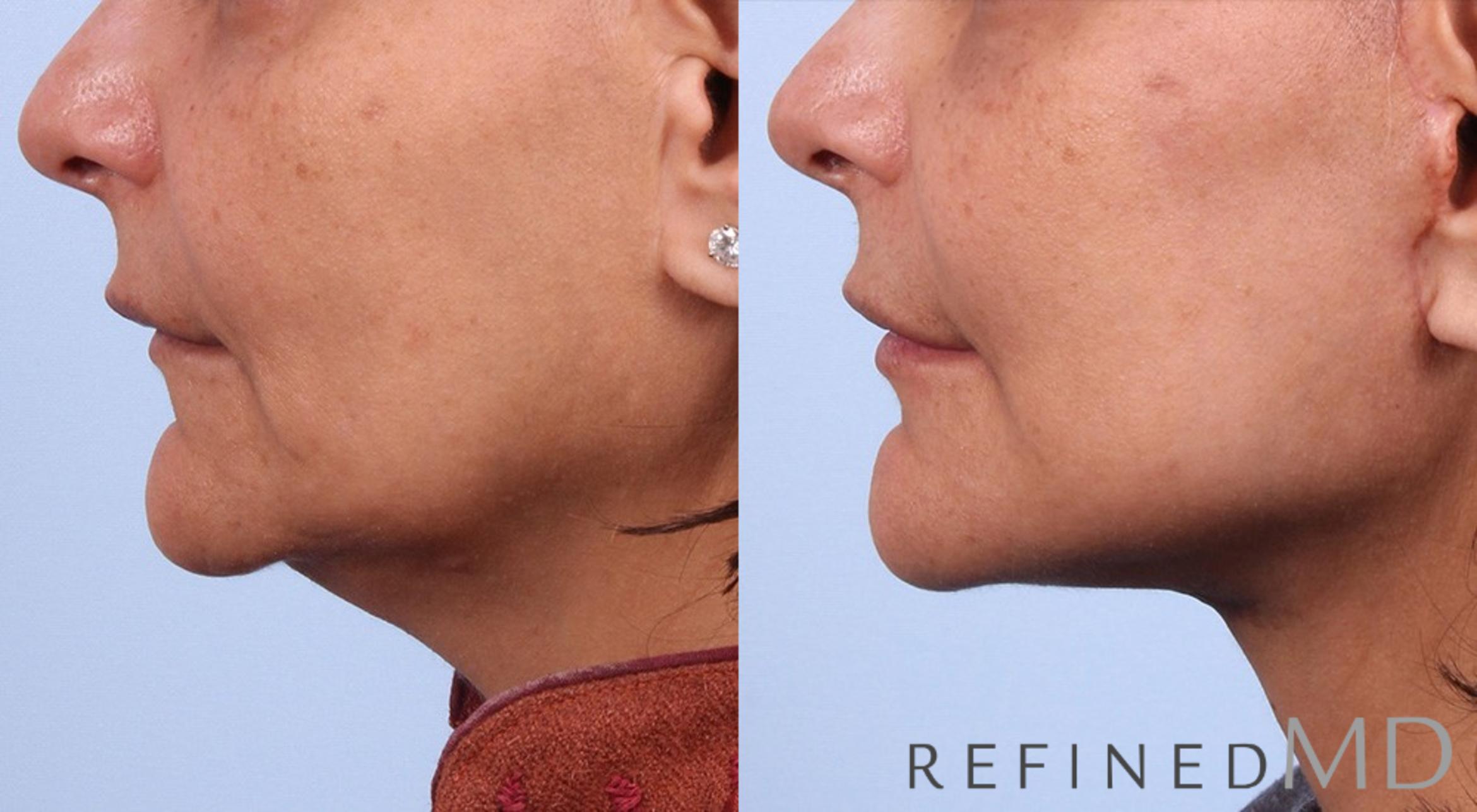 Before & After Facelift Case 1027 View 3 View in Los Gatos & San Jose, CA