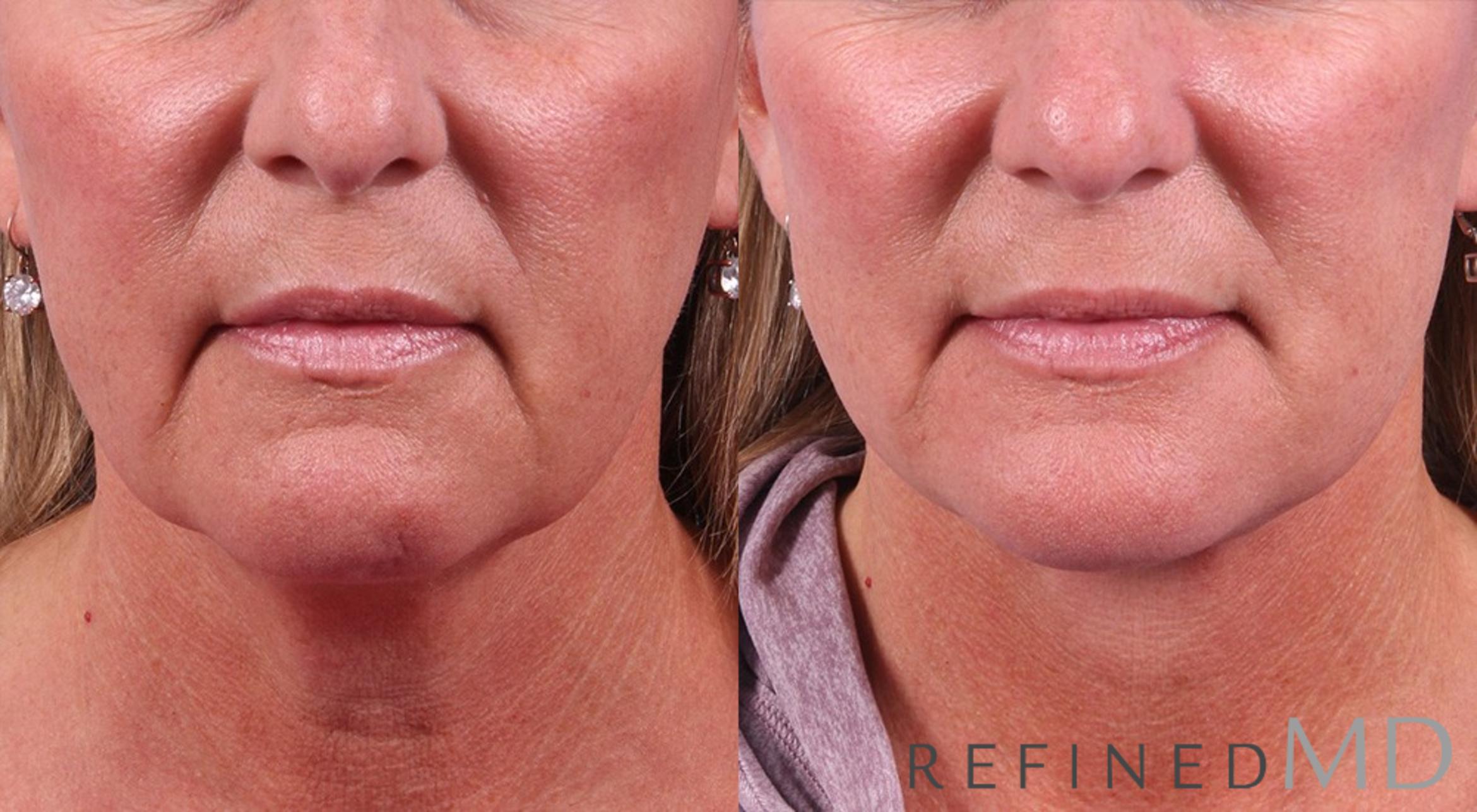 Before & After Facelift Case 1028 View 1 View in Los Gatos & San Jose, CA