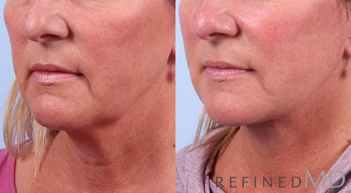 Before & After Facelift Case 1028 View 2 View in Los Gatos & San Jose, CA