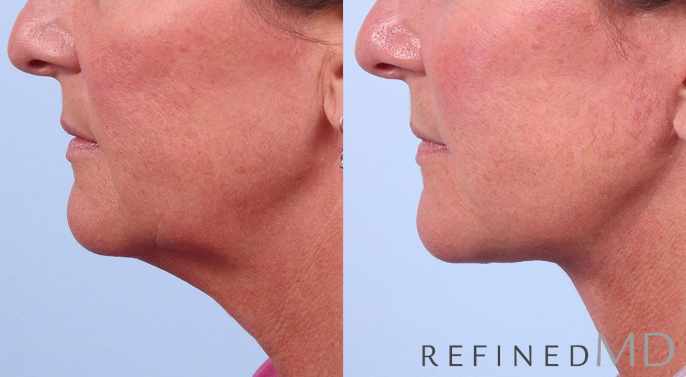 Before & After Facelift Case 1028 View 3 View in Los Gatos & San Jose, CA