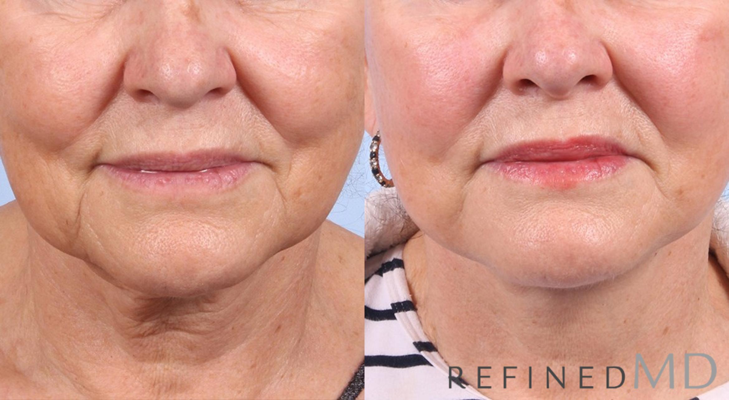 Before & After Facelift Case 1029 View 1 View in Los Gatos & San Jose, CA