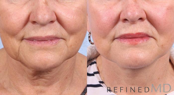 Before & After Facelift Case 1029 View 1 View in Los Gatos & San Jose, CA