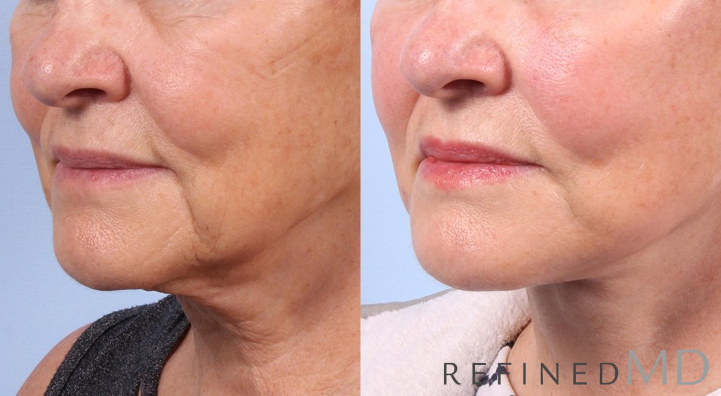 Before & After Facelift Case 1029 View 2 View in Los Gatos & San Jose, CA
