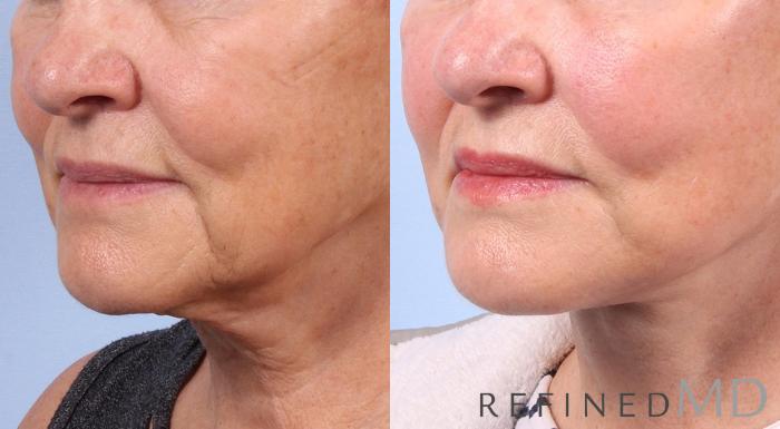 Before & After Facelift Case 1029 View 2 View in Los Gatos & San Jose, CA