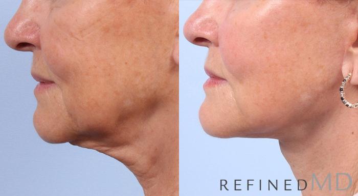 Before & After Facelift Case 1029 View 3 View in Los Gatos & San Jose, CA