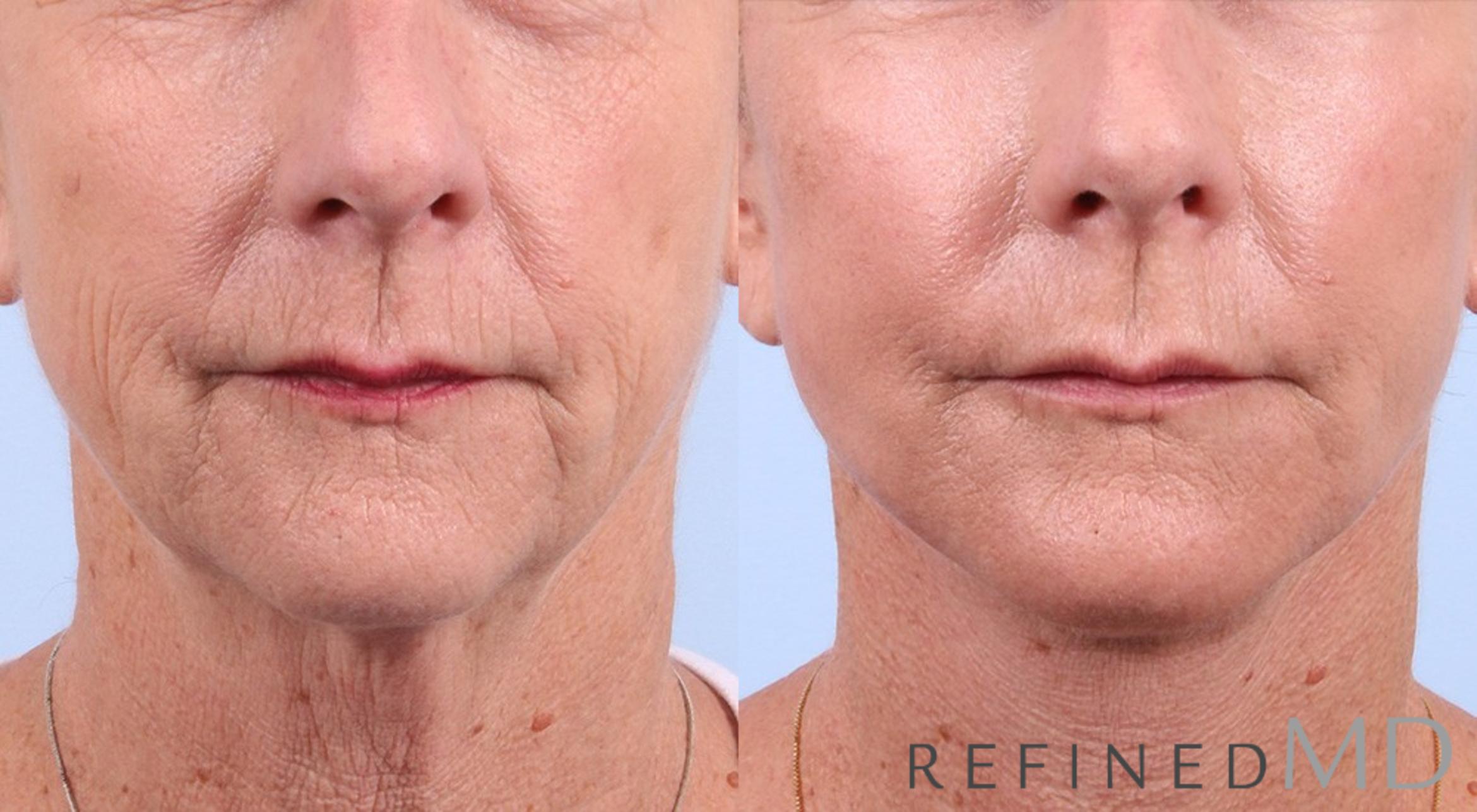 Before & After Facelift Case 1030 View 1 View in Los Gatos & San Jose, CA