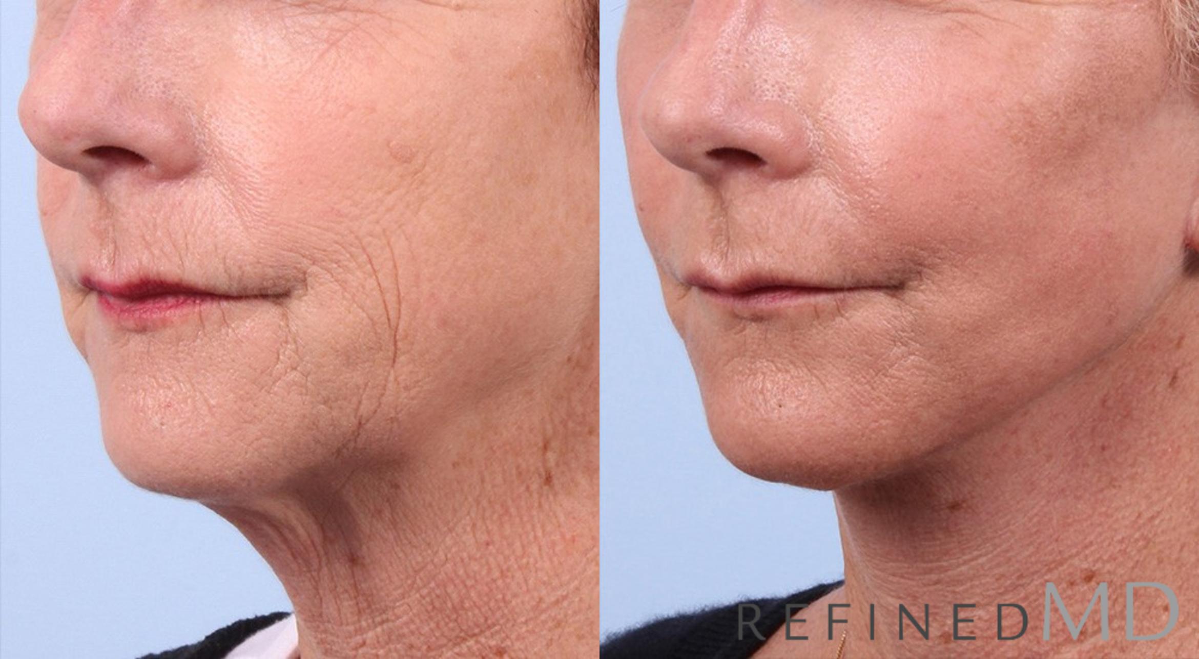 Before & After Facelift Case 1030 View 2 View in Los Gatos & San Jose, CA