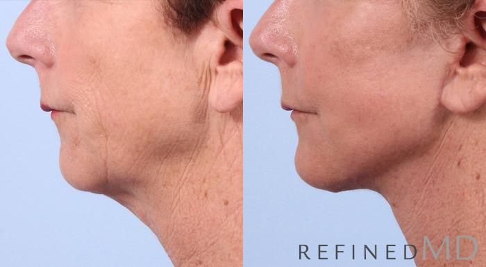 Before & After Facelift Case 1030 View 3 View in Los Gatos & San Jose, CA
