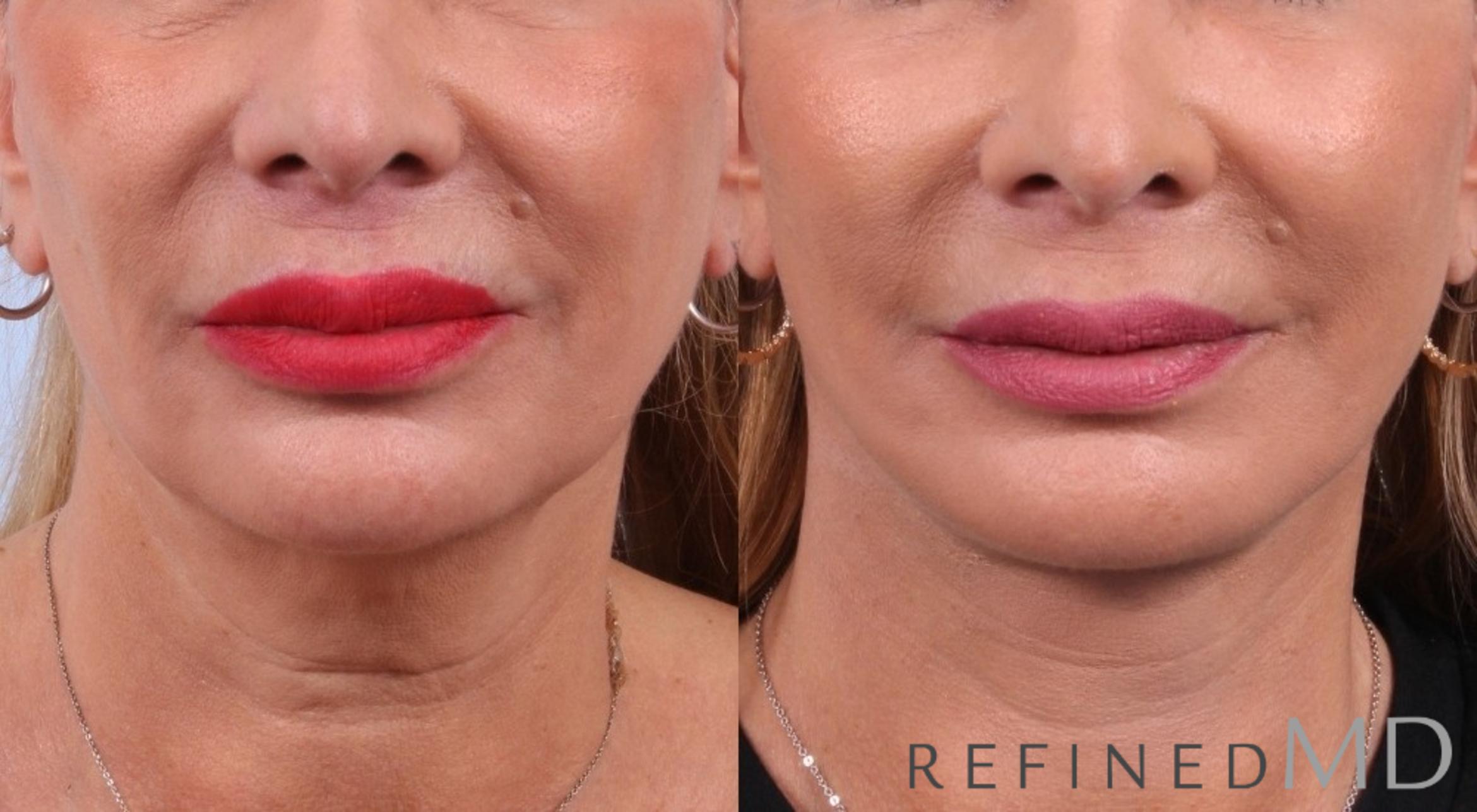Before & After Facelift Case 1031 View 1 View in Los Gatos & San Jose, CA