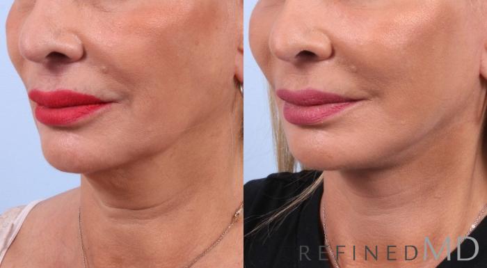 Before & After Facelift Case 1031 View 2 View in Los Gatos & San Jose, CA