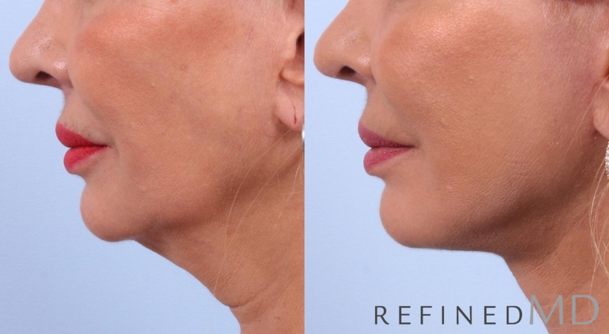 Before & After Facelift Case 1031 View 3 View in Los Gatos & San Jose, CA
