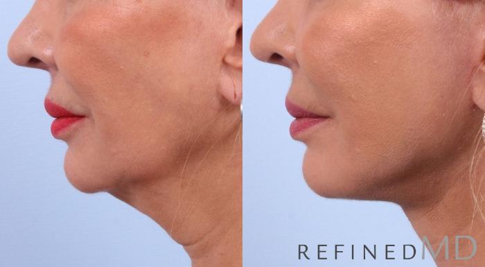 Before & After Facelift Case 1031 View 3 View in Los Gatos & San Jose, CA