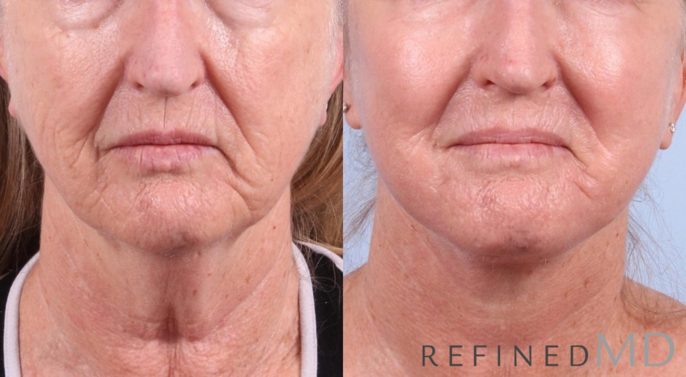 Before & After Facelift Case 1032 View 1 View in Los Gatos & San Jose, CA
