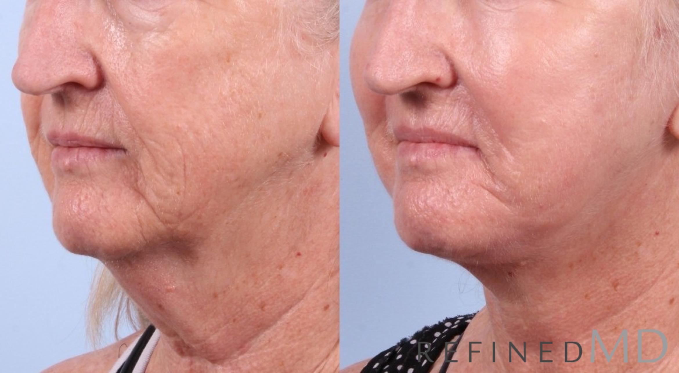 Before & After Facelift Case 1032 View 2 View in Los Gatos & San Jose, CA