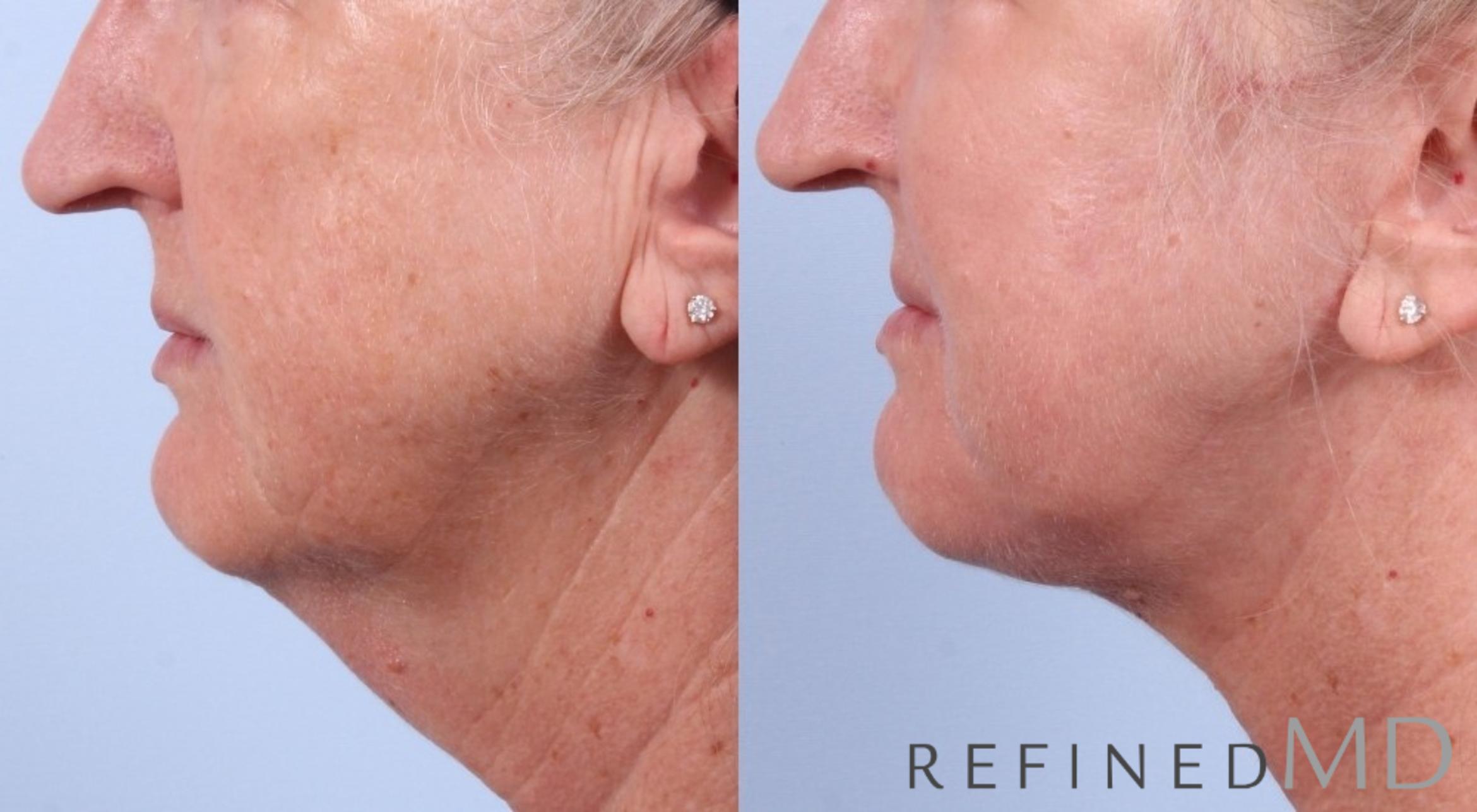 Before & After Facelift Case 1032 View 3 View in Los Gatos & San Jose, CA