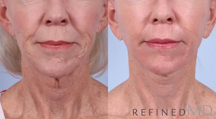 Before & After Facelift Case 1033 View 1 View in Los Gatos & San Jose, CA