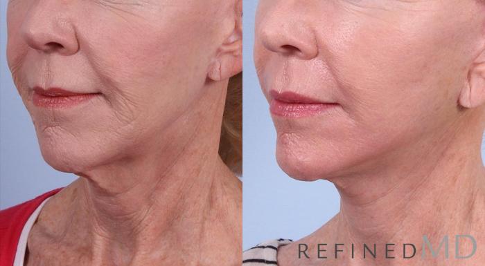 Before & After Facelift Case 1033 View 2 View in Los Gatos & San Jose, CA