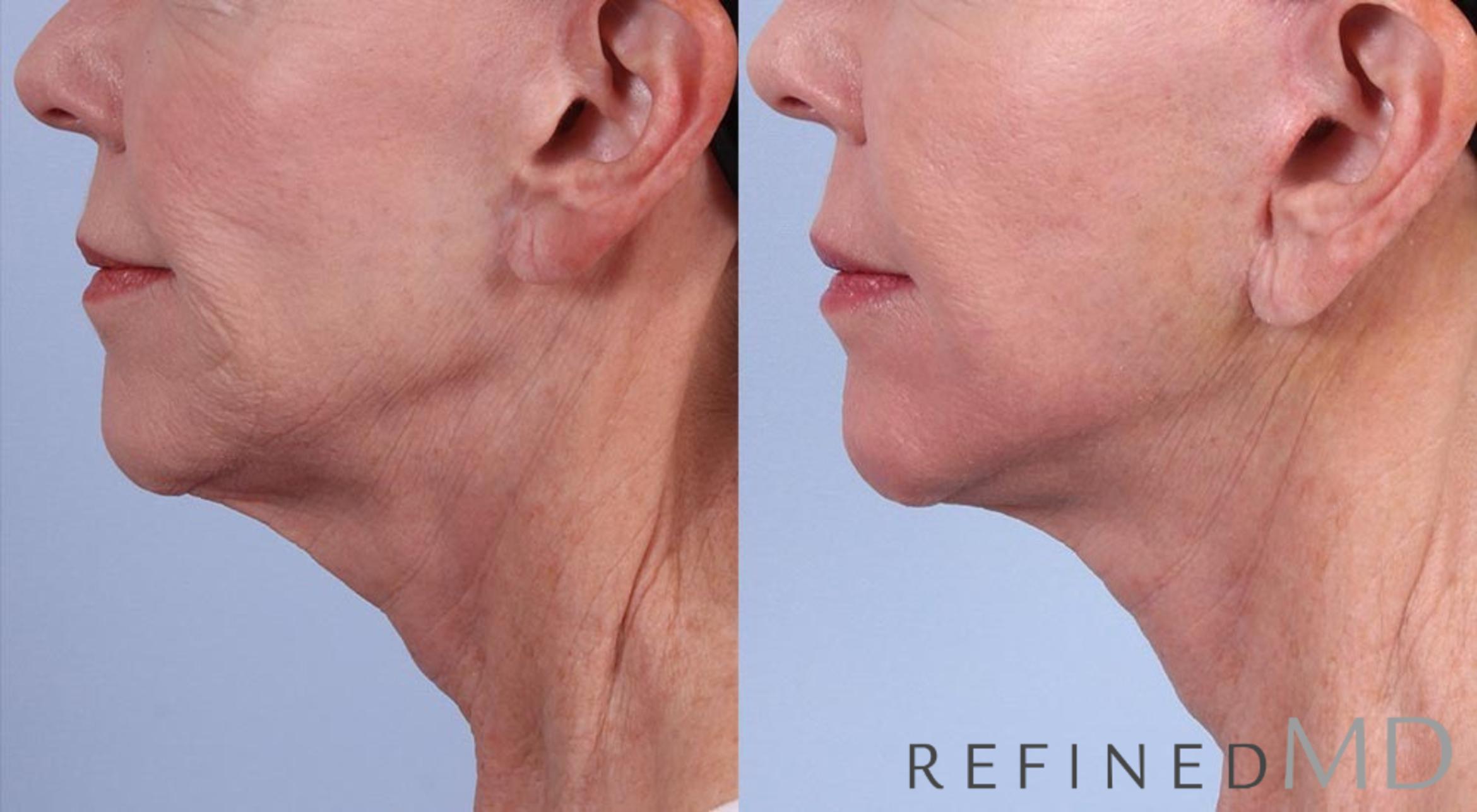 Before & After Facelift Case 1033 View 3 View in Los Gatos & San Jose, CA