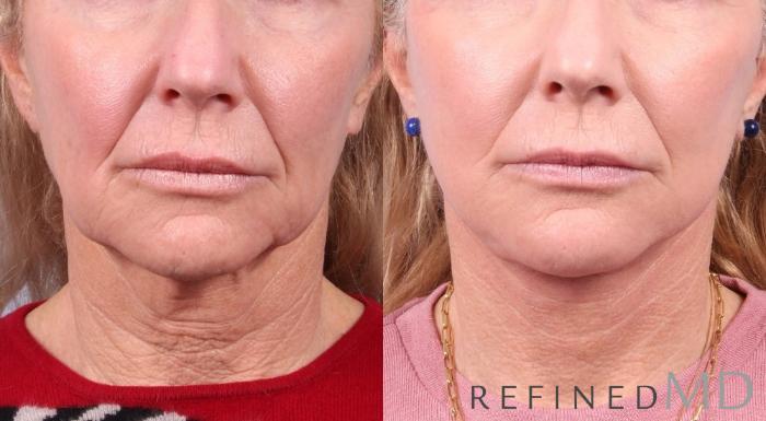 Before & After Facelift Case 1034 View 1 View in Los Gatos & San Jose, CA
