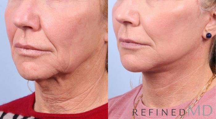 Before & After Facelift Case 1034 View 2 View in Los Gatos & San Jose, CA
