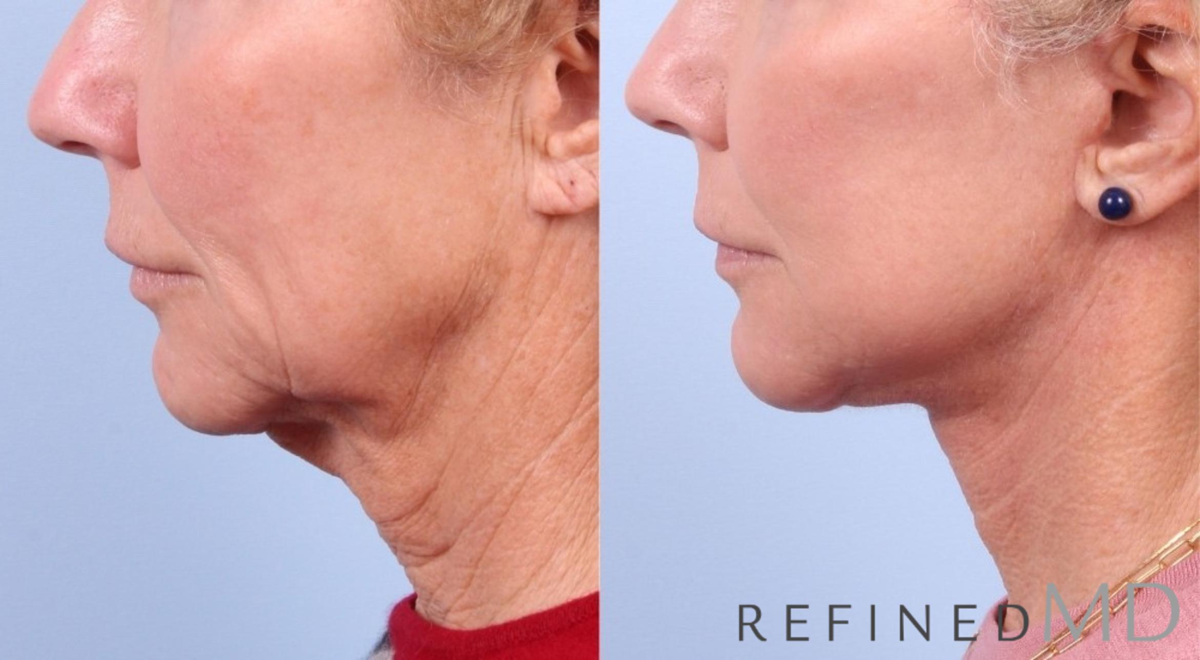Before & After Facelift Case 1034 View 3 View in Los Gatos & San Jose, CA