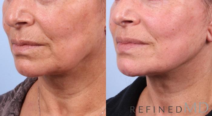 Before & After Facelift Case 1035 View 1 View in Los Gatos & San Jose, CA