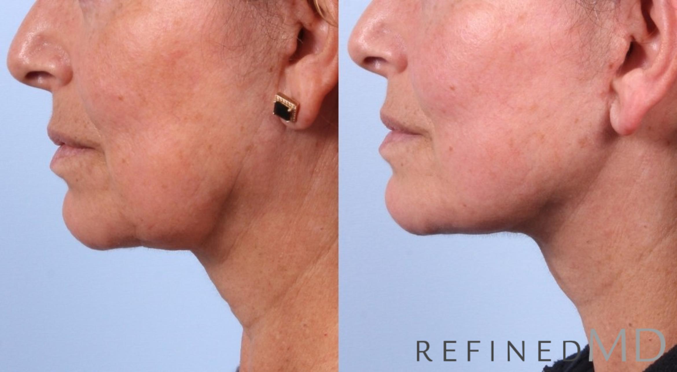 Before & After Facelift Case 1035 View 2 View in Los Gatos & San Jose, CA