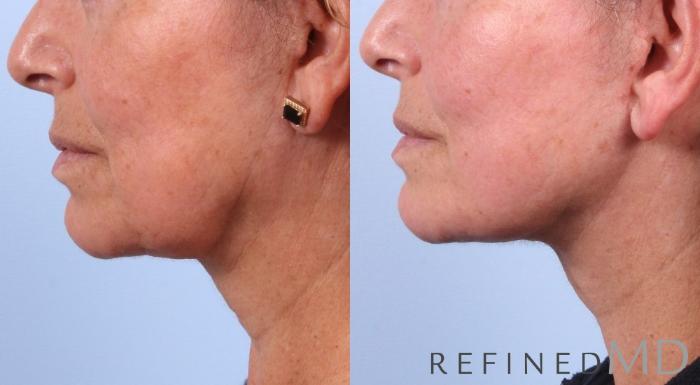 Before & After Facelift Case 1035 View 2 View in Los Gatos & San Jose, CA