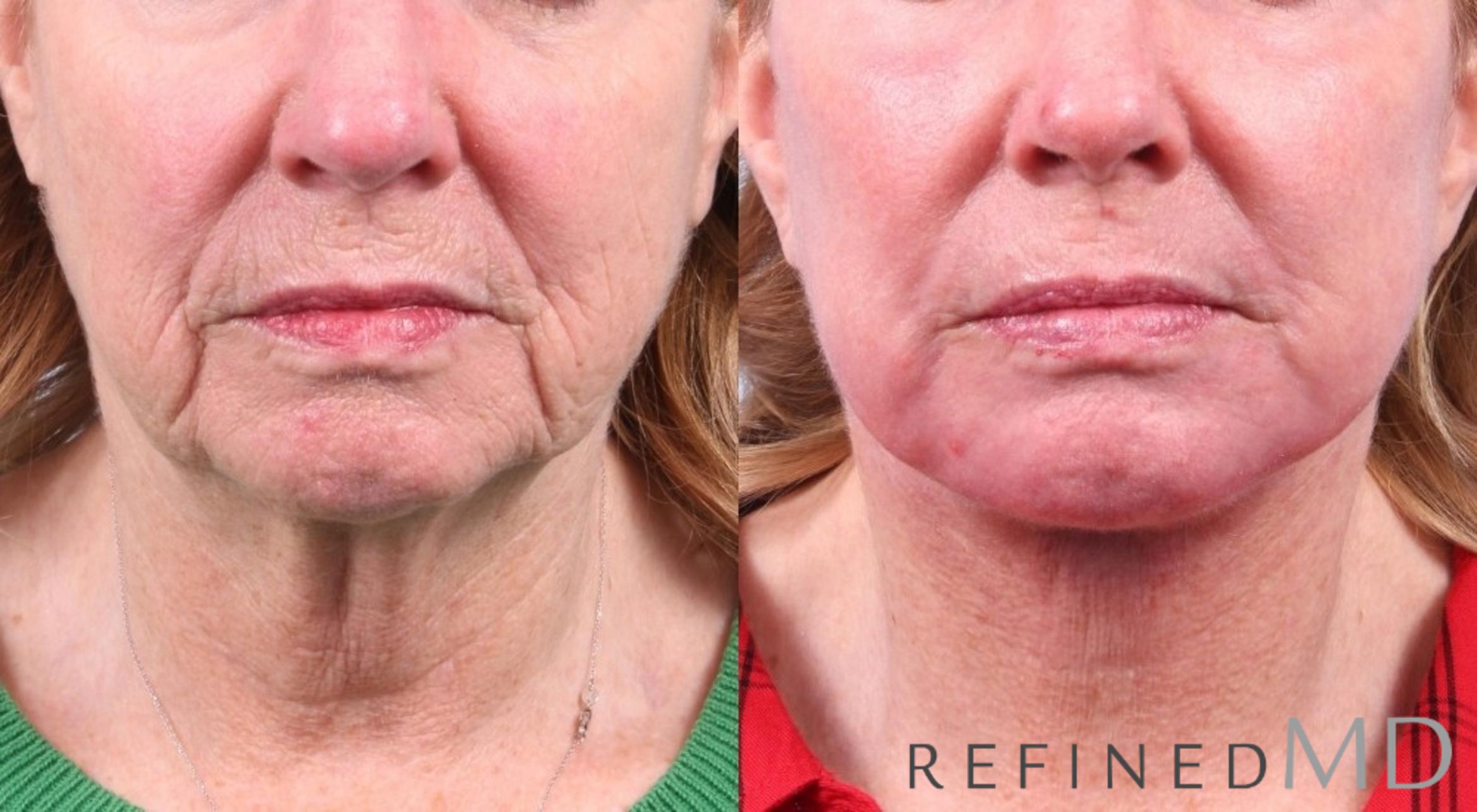 Before & After Facelift Case 1036 View 1 View in Los Gatos & San Jose, CA