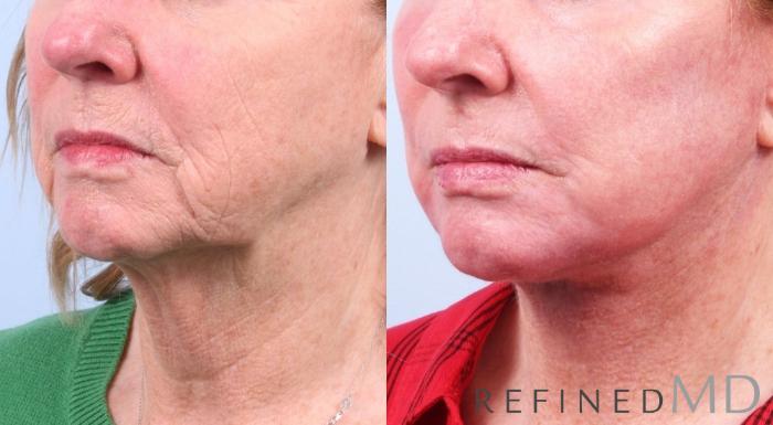 Before & After Facelift Case 1036 View 2 View in Los Gatos & San Jose, CA