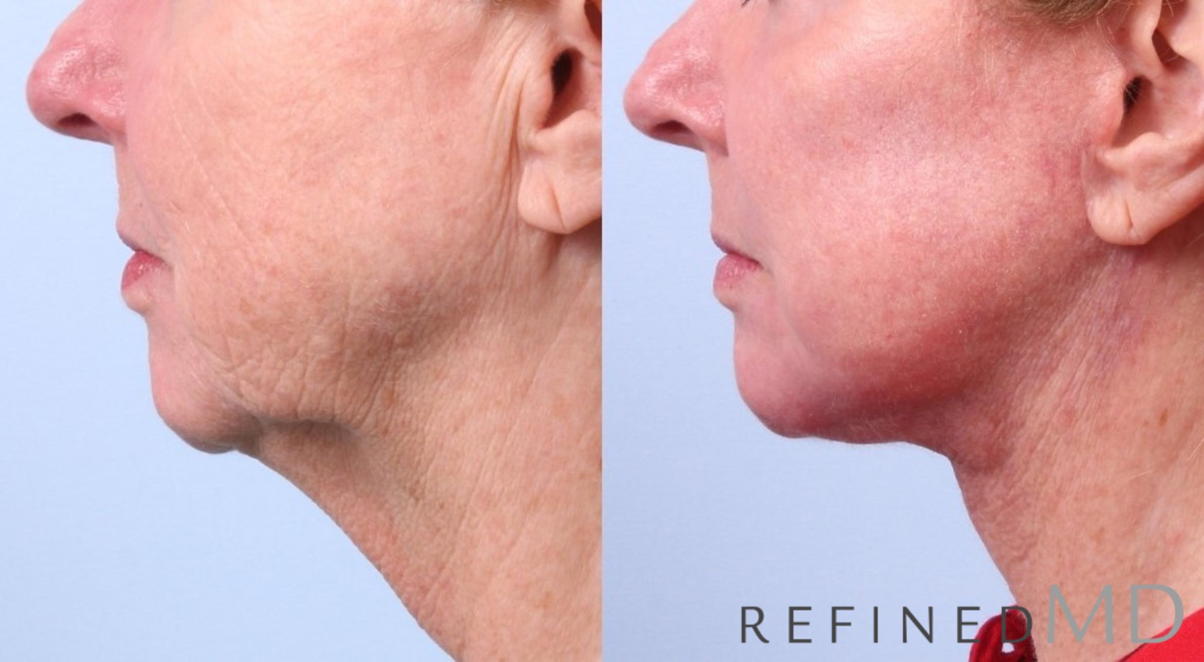 Before & After Facelift Case 1036 View 3 View in Los Gatos & San Jose, CA