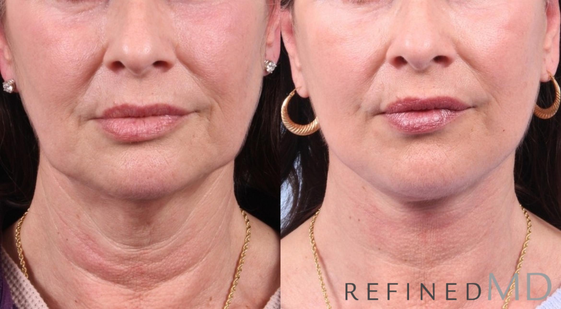 Before & After Facelift Case 1037 View 1 View in Los Gatos & San Jose, CA