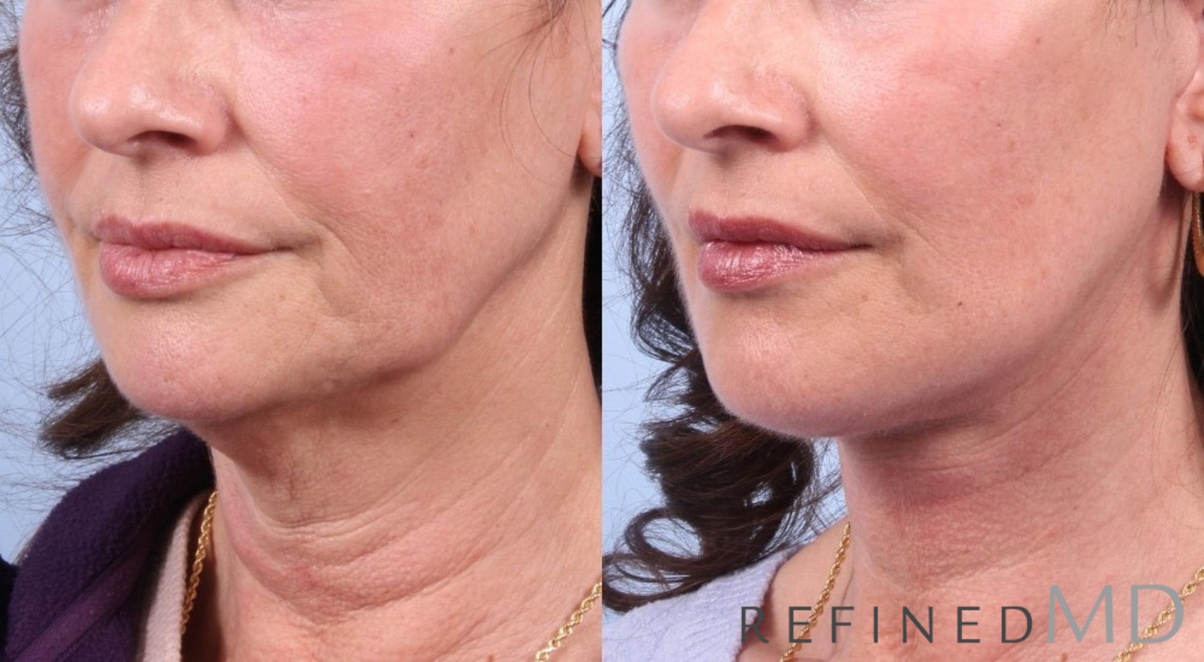 Before & After Facelift Case 1037 View 2 View in Los Gatos & San Jose, CA