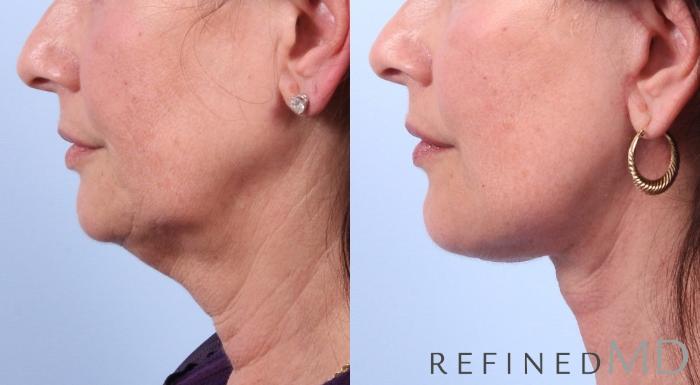 Before & After Facelift Case 1037 View 3 View in Los Gatos & San Jose, CA