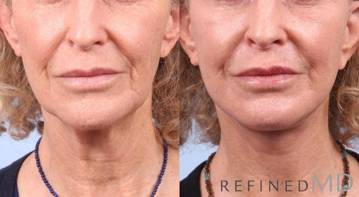 Before & After Facelift Case 1038 View 1 View in Los Gatos & San Jose, CA