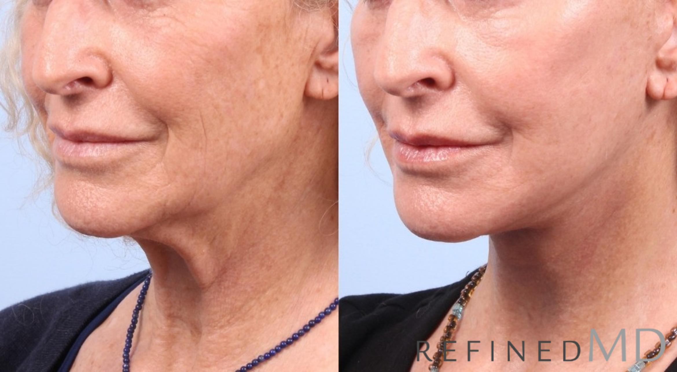 Before & After Facelift Case 1038 View 2 View in Los Gatos & San Jose, CA