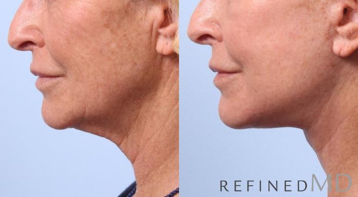 Before & After Facelift Case 1038 View 3 View in Los Gatos & San Jose, CA