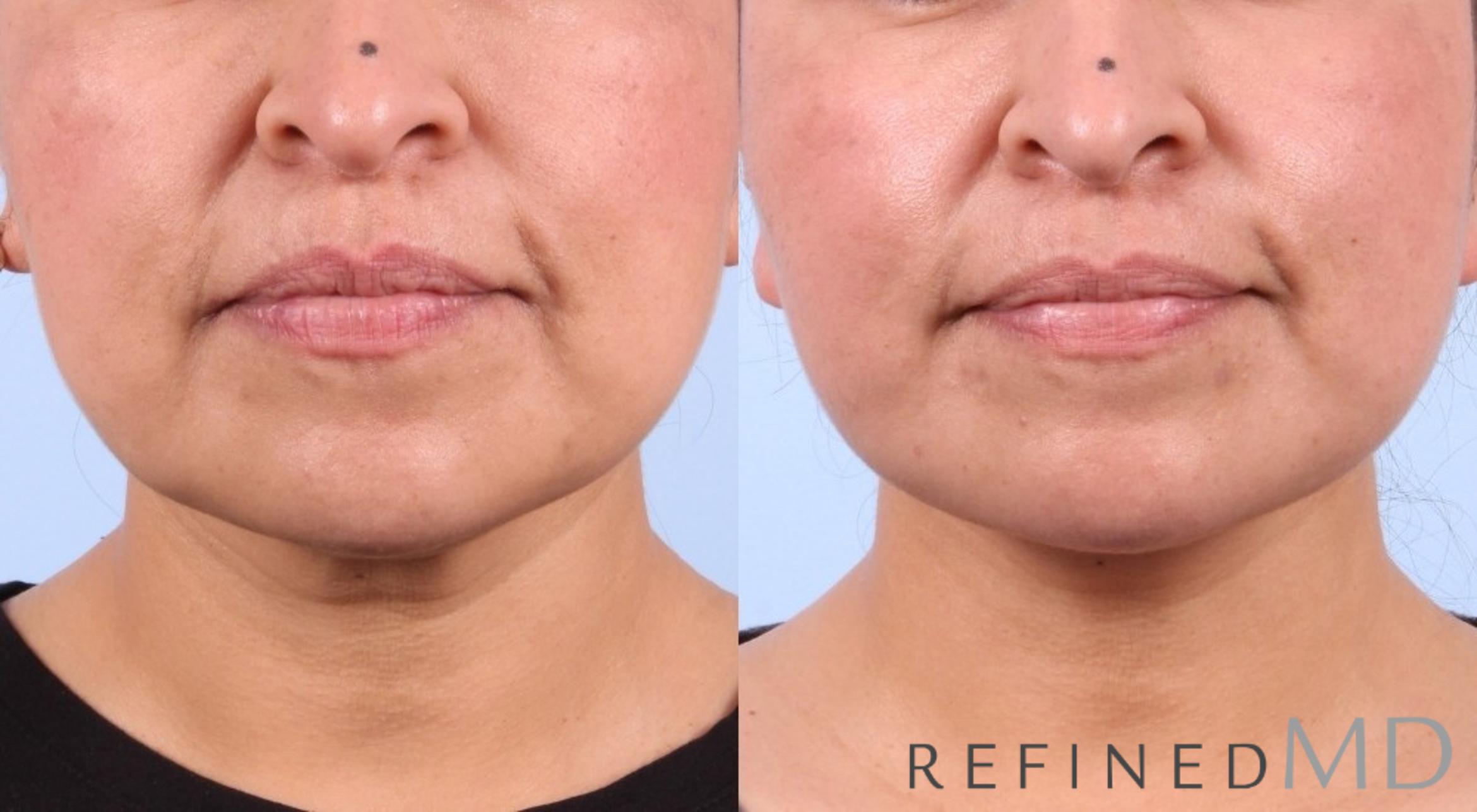 Before & After Facelift Case 1039 View 1 View in Los Gatos & San Jose, CA
