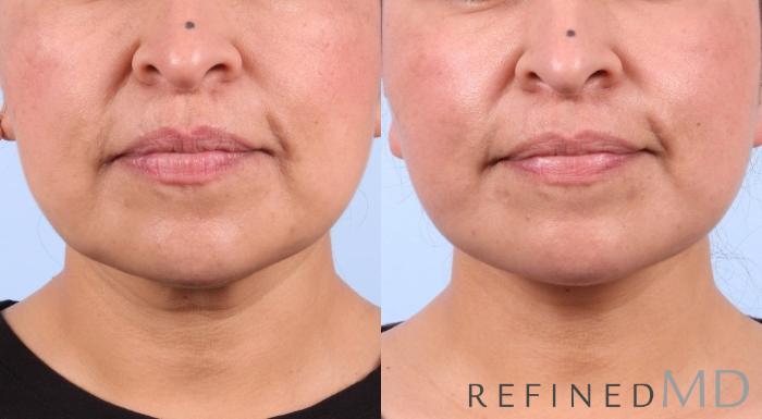 Before & After Facelift Case 1039 View 1 View in Los Gatos & San Jose, CA