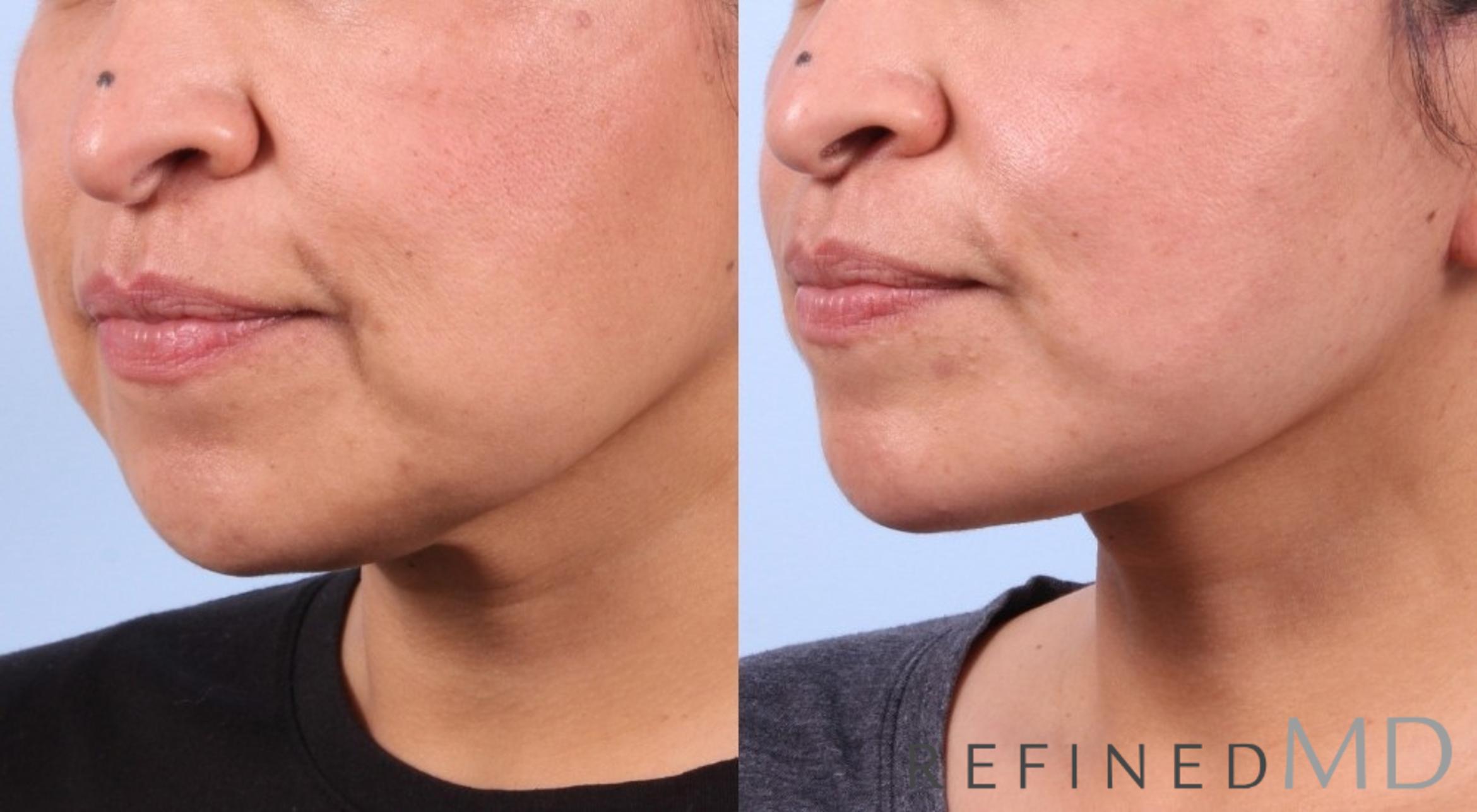 Before & After Facelift Case 1039 View 2 View in Los Gatos & San Jose, CA