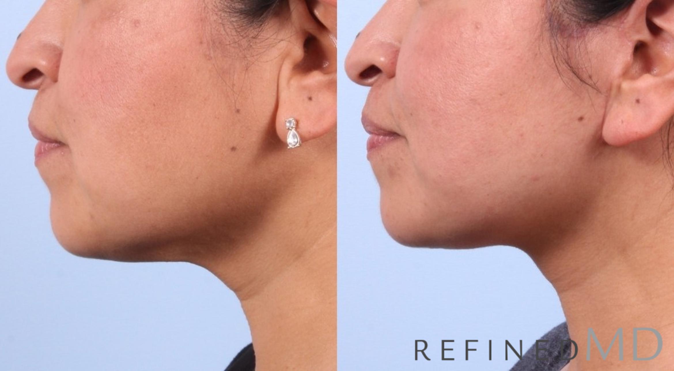 Before & After Facelift Case 1039 View 3 View in Los Gatos & San Jose, CA
