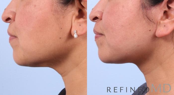 Before & After Facelift Case 1039 View 3 View in Los Gatos & San Jose, CA