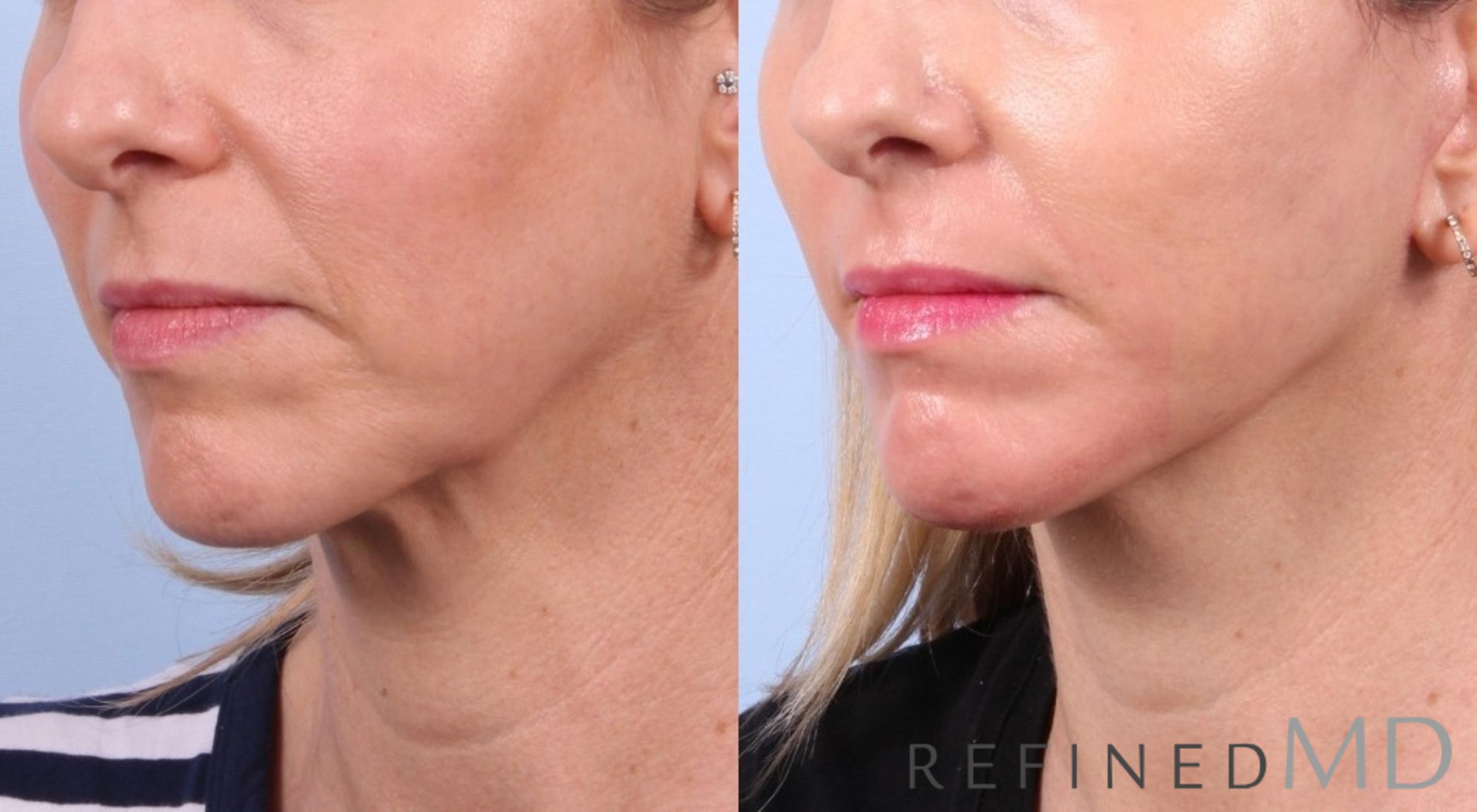 Before & After Facelift Case 1040 View 1 View in Los Gatos & San Jose, CA